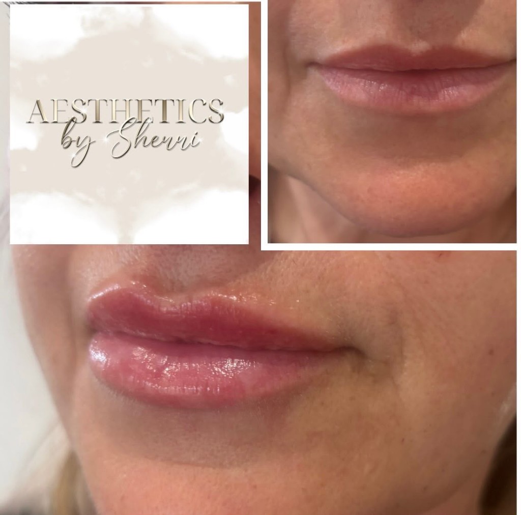 Lip Enhancement